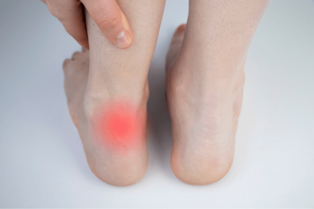 Achilles tendinopathy 1 image 29