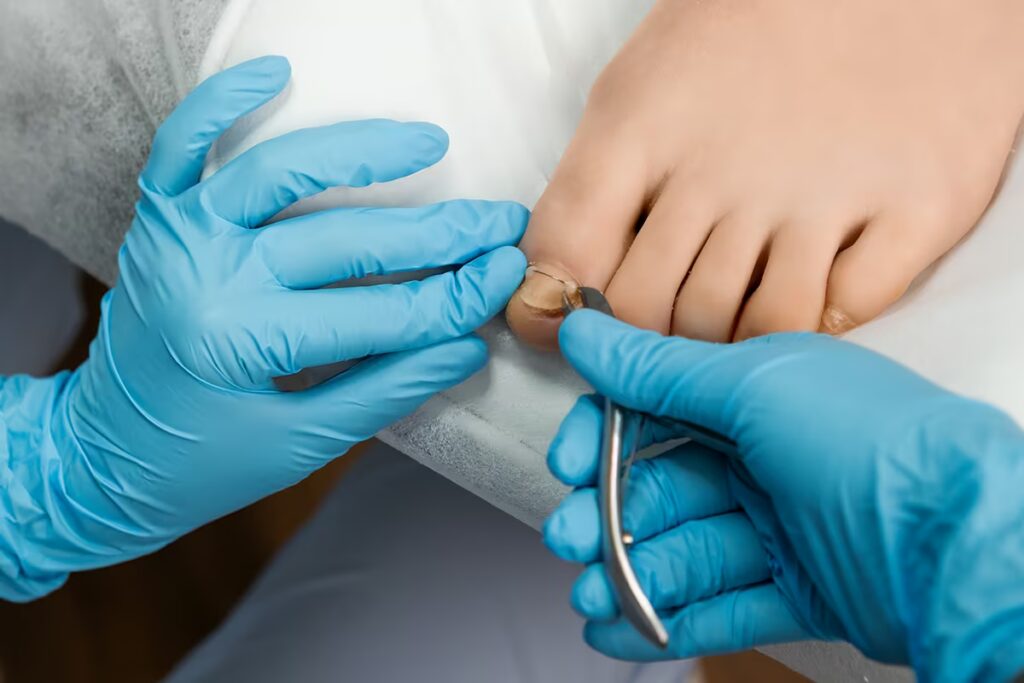 Ingrown Toenails